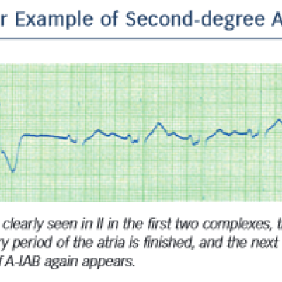 Figure 5 A Clear Example of Second-degree Advanced IAB