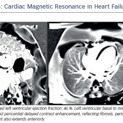 Figure 5 Cardiac Magnetic Resonance in Heart Failure