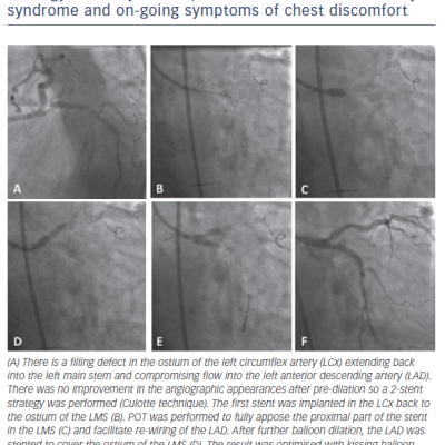 Figure 5 Case example of POT during a two-stent strategy in a 79-year-old patient with an acute coronary syndrome and on-going symptoms of chest discomfort