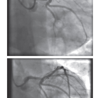 Case Report of an Anterior ST Segment Elevation Myocardial Infarction Due to Distal Left Main Stem and Proximal Left Anterior Descending Disease Treated with a Single Drug-coated Balloon and Angiographic Follow-up at 4 Months