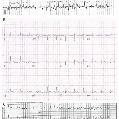 Figure 5 Catecholaminergic Polymorphic Ventricular Tachycardia and Early Repolarisation Syndrome
