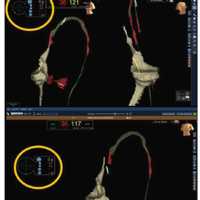 Contact-force Catheter Inserted Through the Femoral Artery