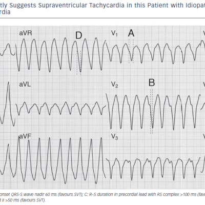 Figure 5 Criteria Incorrectly Suggests Supraventricular Tachycardia in this Patient with Idiopathic Left Bundle Branch Block Ventricular Tachycardia