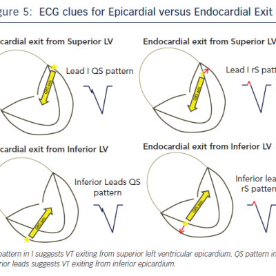 ECG clues for Epicardial Versus Endocardial Exit