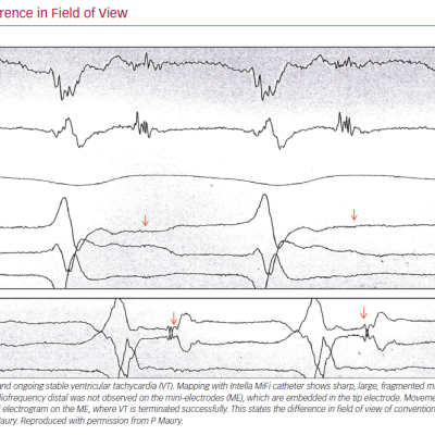 Example of Difference in Field of View