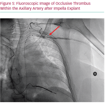Fluoroscopic Image of Occlusive Thrombus