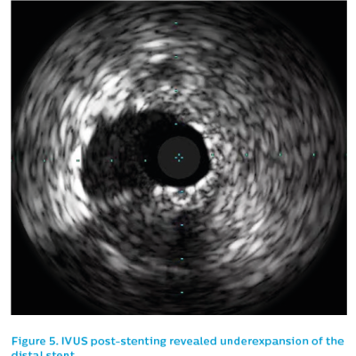 Figure 5. IVUS post-stenting revealed underexpansion of the distal stent