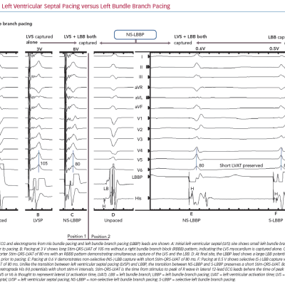 Left Ventricular Septal Pacing versus