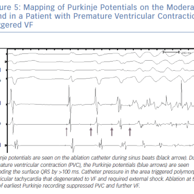 Mapping of Purkinje Potentials on the Moderator Band in a Patient with Premature Ventricular Contractiontriggered VF