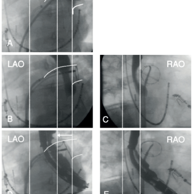 Figure 5 Oesophageal Displacement with a Transoesophageal Echocardiography TOE Probe