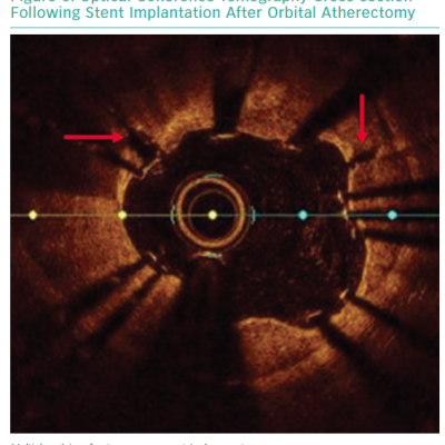 Optical Coherence Tomography Cross-section