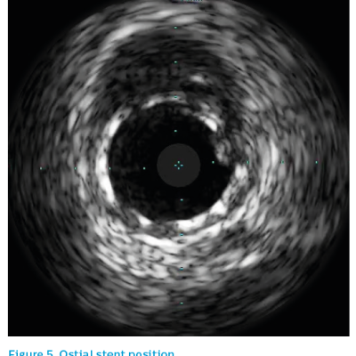 Figure 5. Ostial stent position