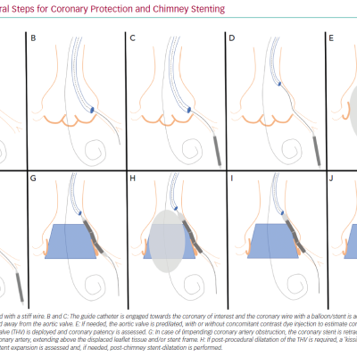 Procedural Steps for Coronary Protection