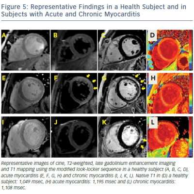 Figure 5 Representative Findings In A Health Subject And In Subjects With Acute And Chronic Myocarditis