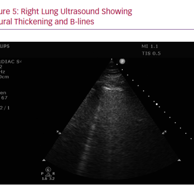 Right Lung Ultrasound Showing Pleural Thickening and B-lines