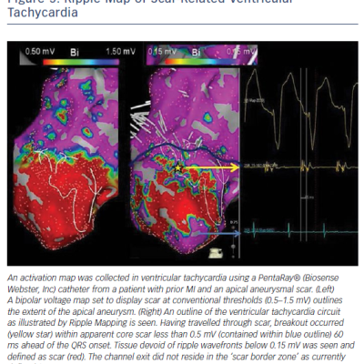 Ripple Map of Scar-Related Ventricular Tachycardia