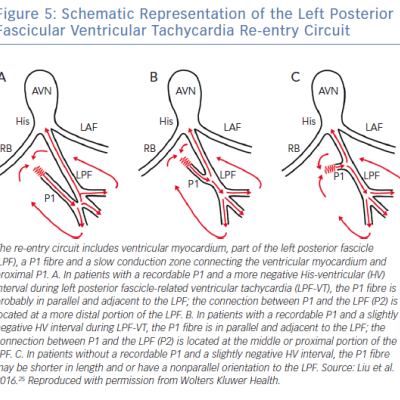 Schematic Representation of the Left Posterior Fascicular Ventricular Tachycardia Re-entry Circuit