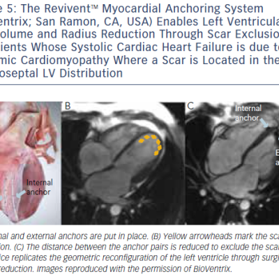 The ReviventTM Myocardial Anchoring System