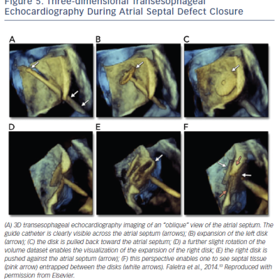 Figure 5 Three-dimensional Transesophageal Echocardiography During Atrial Septal Defect Closure