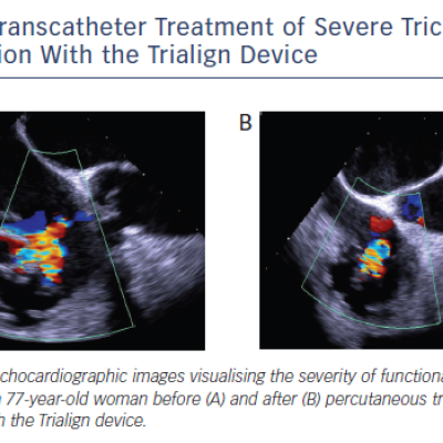 Figure 5 Transcatheter Treatment of Severe Tricuspid Regurgitation With the Trialign Device