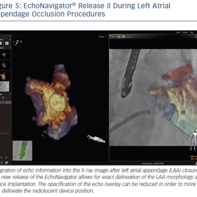 EchoNavigator® Release II During Left Atrial Appendage Occlusion Procedures