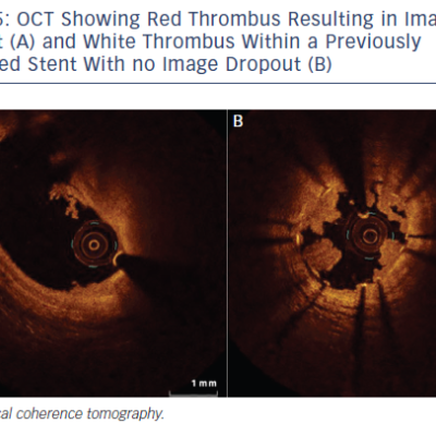 Figure 5 OCT Showing Red Thrombus Resulting in Image Dropout A and White Thrombus Within a Previously Implanted Stent With no Image Dropout B