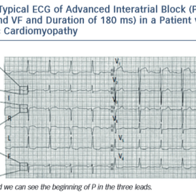 Figure 6 Typical ECG of Advanced Interatrial Block P ± in II III and VF and Duration of 180 ms in a Patient with Ischaemic Cardiomyopathy