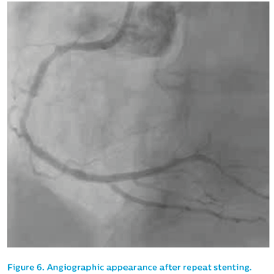 Figure 6. Angiographic appearance after repeat stenting