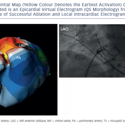 Figure 6 Biventricular Isopotential Map Yellow Colour Denotes the Earliest Activation During Premature VentricularComplex 12-Lead ECG. Inserted is an Epicardial Virtual Electrogram QS Morphology from the Earliest Site. TheFluoroscopic Image at the Site of Successful Ablation and Local Intracardiac Electrogram are Shown As Well