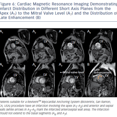 Figure 6 Cardiac Magnetic Resonance Imaging Demonstrating