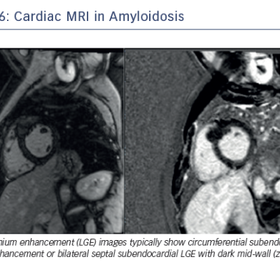 Figure 6 Cardiac MRI in Amyloidosis