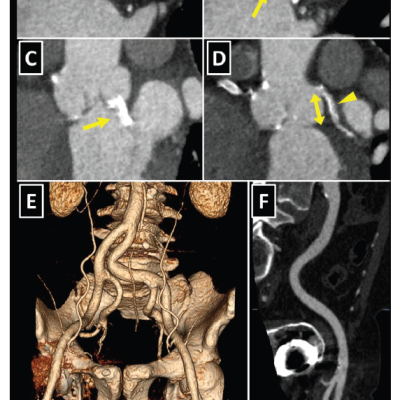 Figure 6 CT in Pre-procedural Assessment for Transcatheter Aortic Valve Replacement TAVR
