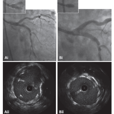 Figure 6 Improved strut apposition and restoration of circularity when POT was performed