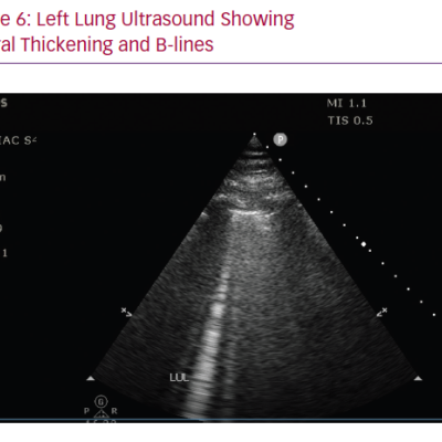 Left Lung Ultrasound Showing Pleural Thickening and B-lines