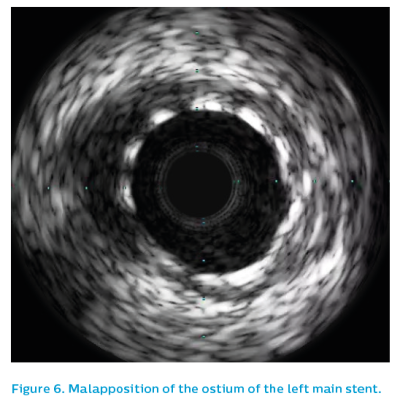 Figure 6. Malapposition of the ostium of the left main stent