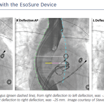 Figure 6 Oesophageal Displacement with the EsoSure Device