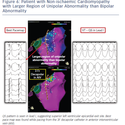 Larger Region of Unipolar Abnormality then Bipoalr Abnormality