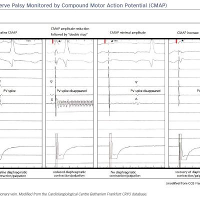 Figure 6 Phrenic Nerve Palsy Monitored by Compound Motor Action Potential CMAP
