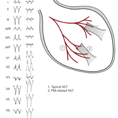 Re-entry Circuit of Idiopathic Ventricular Tachycardia