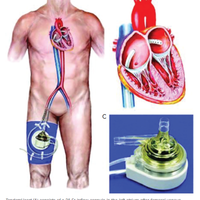 Figure 6 The TandemHeart Kit