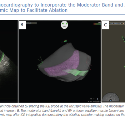 Use of Intracardiac Echocardiography to Incorporate the Moderator Band