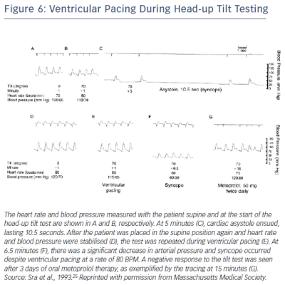 Figure 6 Ventricular Pacing During Head-up Tilt Testing