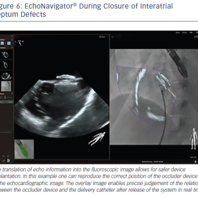 EchoNavigator® During Closure of Interatrial Septum Defects