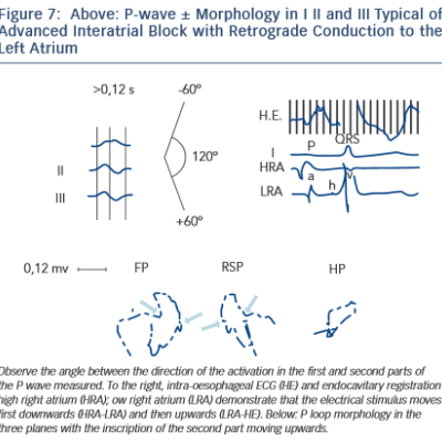 Figure 7 Above P-wave ± Morphology in I II and III Typical of Advanced Interatrial Block with Retrograde Conduction to the Left Atrium