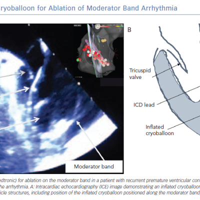 Adjuvant Use of a Cryoballoon for Ablation of Moderator Band Arrhythmia