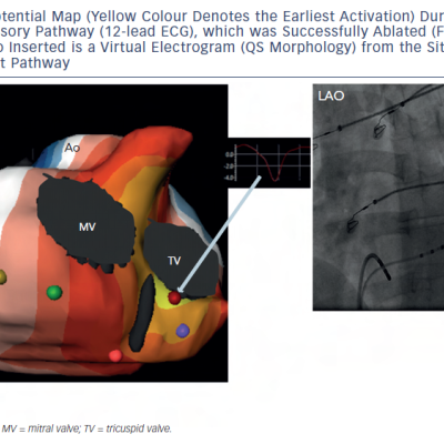 Figure 7 Biventricular Isopotential Map Yellow Colour Denotes the Earliest Activation During Pre-excitation froma Right Posteroseptal Accessory Pathway 12-lead ECG which was Successfully Ablated Fluoroscopic Image atthe Corresponding Site. Also Inserted is a Virtual Electrogram QS Morphology from the Site of Earliest VentricularActivation Over the Manifest Pathway