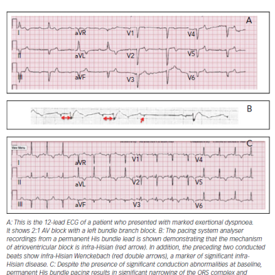 Correction of Left Bundle Branch Block with Permanent His Bundle Pacing