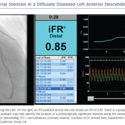 Figure 7 iFR Pullback Across Serial Stenosis in a Diffusely Diseased Left Anterior Descending