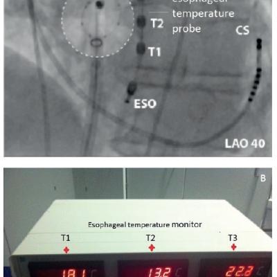 Figure 7 Oesophageal Temperature Probe A and Monitor B