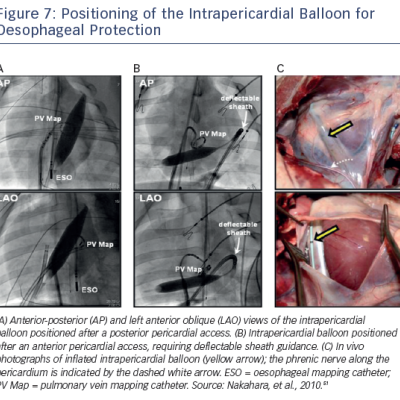 Figure 7 Positioning of the Intrapericardial Balloon for Oesophageal Protection
